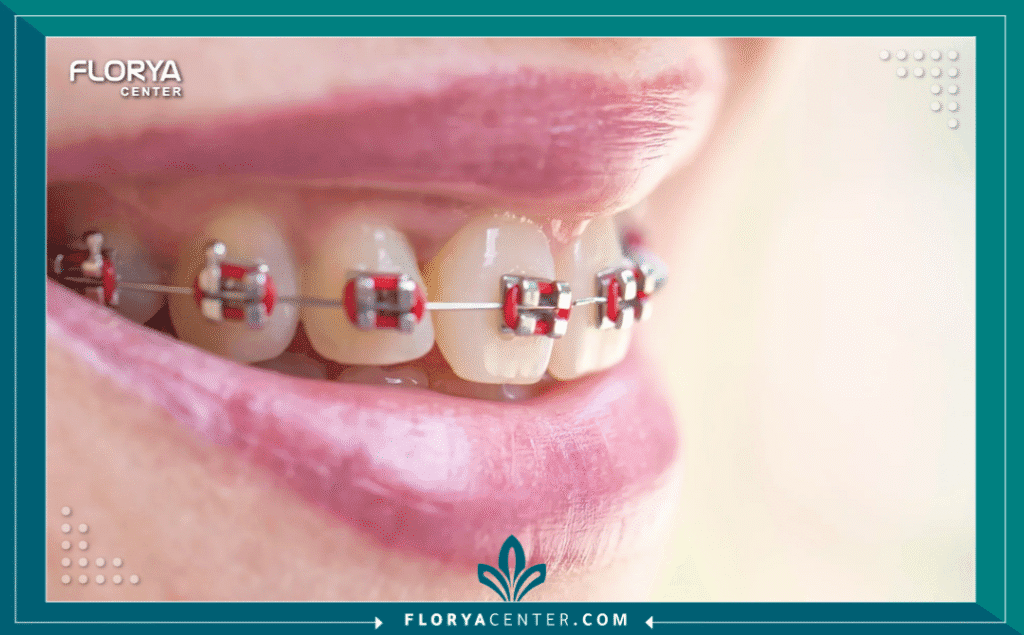 nouralagee93@gmail.com 20250720 114000 ٠٠٠٠ - العناية بالأسنان أثناء التقويم تعتبر العناية بالأسنان أثناء التقويم (Orthodontic Dental Care) التحدي الأكبر والضمان الأوحد لنجاح رحلة الحصول على ابتسامة مستقيمة وصحية. إن تركيب تقويم الأسنان، سواء كان معدنياً أو شفافاً، هو استثمار كبير في مستقبلك الجمالي والصحي، لكن هذا الاستثمار يظل ناقصاً تماماً بدون التزام صارم بالنظافة الفموية.