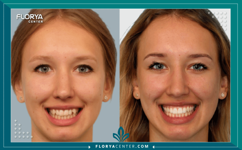 نتائج تقويم الأسنان قبل وبعد 3 nouralagee93@gmail.com 20250721 150433 ٠٠٠٠ - نتائج تقويم الأسنان قبل وبعد تُظهر نتائج تقويم الأسنان قبل وبعد (Orthodontic Treatment) تحولاً جذرياً لا يقتصر فقط على جمال الابتسامة، بل يمتد ليشمل الصحة الفموية والوظيفية الكاملة. يعتقد الكثيرون أن التقويم إجراء تجميلي بحت، ولكنه في جوهره علاج طبي ضروري لتصحيح إطباق الفكين، تحسين المضغ، والوقاية من مشاكل مستقبلية. إن مشاهدة صور نتائج تقويم الأسنان قبل وبعد لحالات واقعية هي الطريقة الأكثر فعالية لفهم القوة العلاجية لطب التقويم.