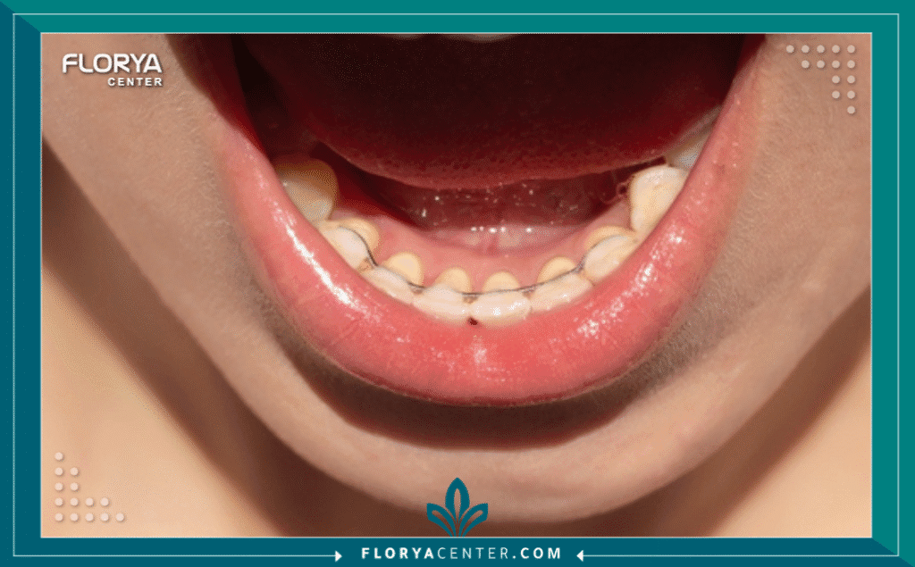 nouralagee93@gmail.com 20250723 112108 ٠٠٠٠ - مثبت التقويم بعد العلاج يُعد مثبت التقويم بعد العلاج (Orthodontic Retainers after Treatment) الخطوة الأكثر أهمية وحسمًا في رحلة تصحيح الابتسامة، فهو الضمان الحقيقي للحفاظ على النتائج التي تم تحقيقها بشق الأنفس. يعتقد الكثيرون أن إزالة أسلاك التقويم هي نهاية المطاف، لكن الحقيقة الطبية، كما تؤكدها الأكاديمية الأمريكية لتقويم الأسنان (AAO)، هي أن مرحلة التثبيت هي البداية الحقيقية للحفاظ على الاستثمار المالي والوقتي. بدون الالتزام بـ "مثبت التقويم بعد العلاج"، تبدأ الأسنان في العودة التدريجية إلى وضعها الأصلي، وهي ظاهرة تُعرف بـ "الانتكاس" (Relapse).