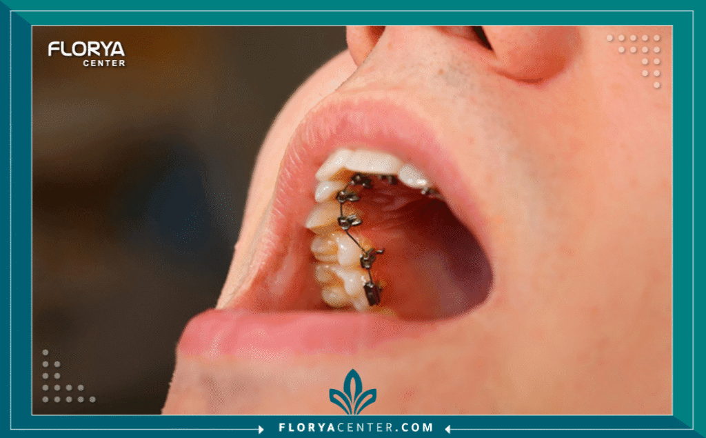 تقويم الأسنان الداخلي (اللساني) 3 nouralagee93@gmail.com 20250723 123349 ٠٠٠٠ - تقويم الأسنان الداخلي (اللساني) يُعد تقويم الأسنان الداخلي (اللساني) (Lingual Braces) ثورة في عالم طب الأسنان التجميلي، مقدماً حلاً فعالاً لا يتنازل عن الجماليات. بالنسبة للعديد من البالغين والمهنيين، كانت فكرة ارتداء تقويم الأسنان المعدني التقليدي الظاهر سبباً لتأجيل حلم الحصول على ابتسامة مصطفة. يأتي تقويم الأسنان الداخلي (اللساني) ليزيل هذا العائق تماماً، فهو يعمل بنفس كفاءة التقويم التقليدي، ولكن مع ميزة جوهرية: إنه مخفي بالكامل خلف الأسنان. يعتمد نجاح هذا الإجراء بشكل كبير على دقة التصميم وخبرة الأخصائي. في "مركز فلوريا"، ندرك أهمية الدقة والجماليات في رحلة علاجك، ونقدم حلولاً متقدمة لضمان تحقيق أفضل النتائج باستخدام تقويم الأسنان الداخلي (اللساني).