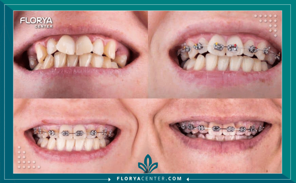 nouralagee93@gmail.com 20250723 154927 ٠٠٠٠ - أفضل عيادة لتقويم الأسنان عندما تبحث عن أفضل عيادة لتقويم الأسنان في تركيا، فإنك لا تبحث فقط عن علاج طبي، بل تبحث عن استثمار طويل الأمد في ابتسامتك وثقتك بنفسك. تعد تركيا، وتحديداً إسطنبول، واحدة من عواصم السياحة العلاجية الرائدة عالمياً، حيث تجمع بين الخبرة الطبية العالية والتكلفة المناسبة. ومع تزايد الخيارات، يصبح العثور على أفضل عيادة لتقويم الأسنان تحدياً يحتاج إلى بحث دقيق لضمان الحصول على نتائج مثالية.