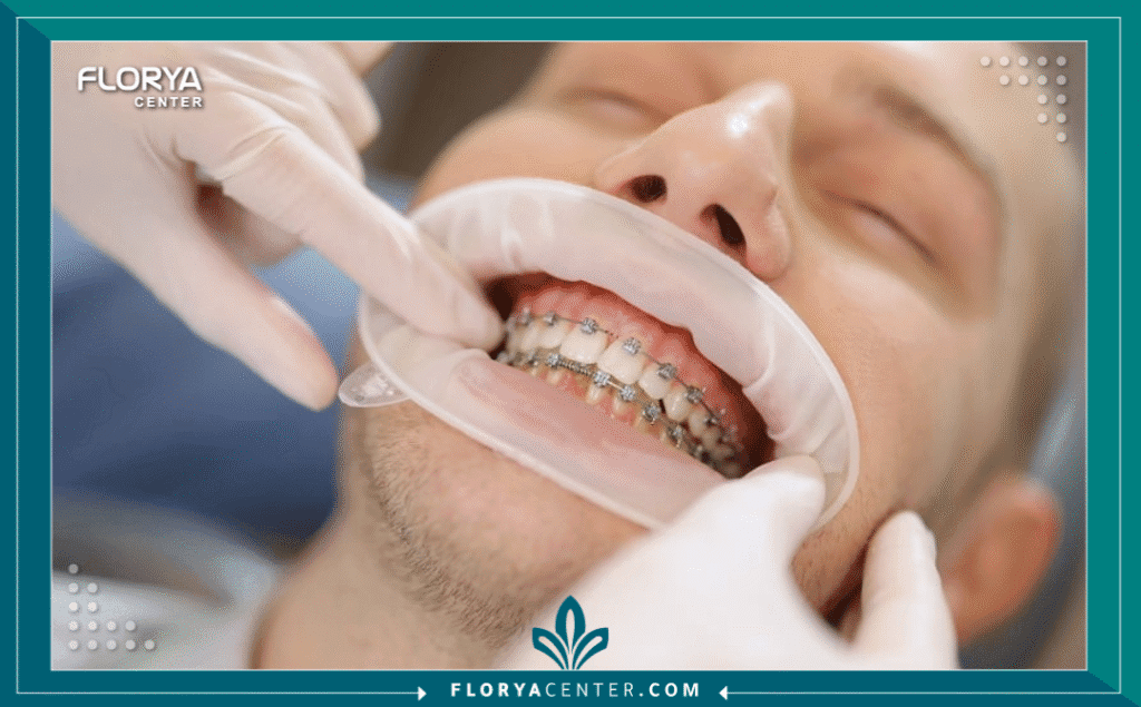 nouralagee93@gmail.com 20250723 154957 ٠٠٠٠ - أفضل عيادة لتقويم الأسنان عندما تبحث عن أفضل عيادة لتقويم الأسنان في تركيا، فإنك لا تبحث فقط عن علاج طبي، بل تبحث عن استثمار طويل الأمد في ابتسامتك وثقتك بنفسك. تعد تركيا، وتحديداً إسطنبول، واحدة من عواصم السياحة العلاجية الرائدة عالمياً، حيث تجمع بين الخبرة الطبية العالية والتكلفة المناسبة. ومع تزايد الخيارات، يصبح العثور على أفضل عيادة لتقويم الأسنان تحدياً يحتاج إلى بحث دقيق لضمان الحصول على نتائج مثالية.