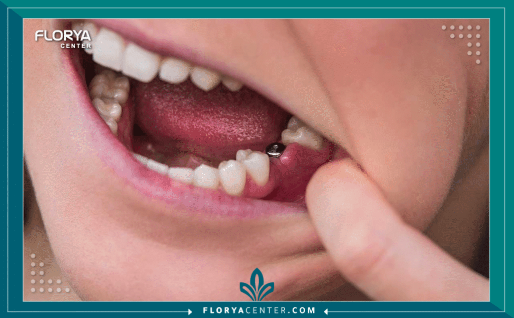 تكلفة زراعة السن الواحد