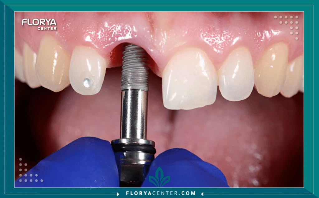 سعر زراعة السن الواحد