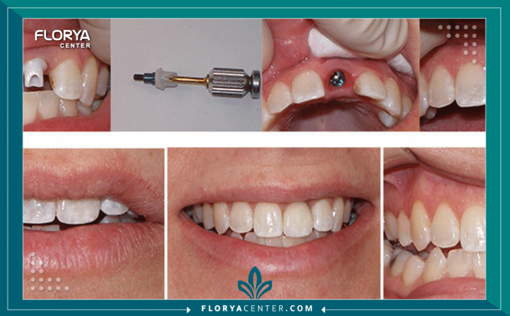 nouralagee93@gmail.com 20250724 172031 ٠٠٠٠ - تكلفة زراعة السن الواحد هل تخيلت يومًا أن استعادة ابتسامتك المفقودة قد تكون بوابة لحياة جديدة مليئة بالثقة؟ إن البحث عن تكلفة زراعة السن الواحد (Dental Implant Cost) ليس مجرد بحث عن رقم مالي، بل هو خطوة نحو استثمار طويل الأمد في صحتك وجاذبيتك. في عالم الطب التجميلي والعلاجي اليوم، لم تعد زراعة الأسنان رفاهية بعيدة المنال، بل أصبحت ضرورة متاحة بفضل التطور الطبي الهائل، خاصة في وجهات عالمية رائدة مثل تركيا. هذا المقال ليس مجرد سرد للأرقام، بل هو خارطة طريق تفصيلية تضع بين يديك كل ما تحتاج معرفته حول سعر زراعة السن الواحد، المعايير الطبية الدقيقة، وكيفية الحصول على أفضل النتائج مع "مركز فلوريا - Floray Center".