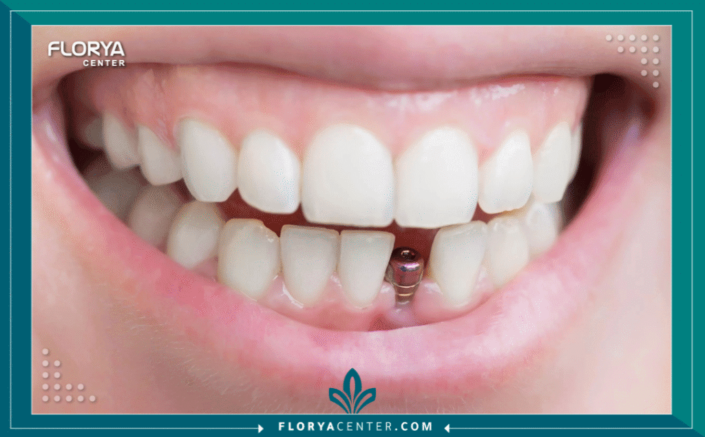 nouralagee93@gmail.com 20250724 172056 ٠٠٠٠ - تكلفة زراعة السن الواحد هل تخيلت يومًا أن استعادة ابتسامتك المفقودة قد تكون بوابة لحياة جديدة مليئة بالثقة؟ إن البحث عن تكلفة زراعة السن الواحد (Dental Implant Cost) ليس مجرد بحث عن رقم مالي، بل هو خطوة نحو استثمار طويل الأمد في صحتك وجاذبيتك. في عالم الطب التجميلي والعلاجي اليوم، لم تعد زراعة الأسنان رفاهية بعيدة المنال، بل أصبحت ضرورة متاحة بفضل التطور الطبي الهائل، خاصة في وجهات عالمية رائدة مثل تركيا. هذا المقال ليس مجرد سرد للأرقام، بل هو خارطة طريق تفصيلية تضع بين يديك كل ما تحتاج معرفته حول سعر زراعة السن الواحد، المعايير الطبية الدقيقة، وكيفية الحصول على أفضل النتائج مع "مركز فلوريا - Floray Center".
