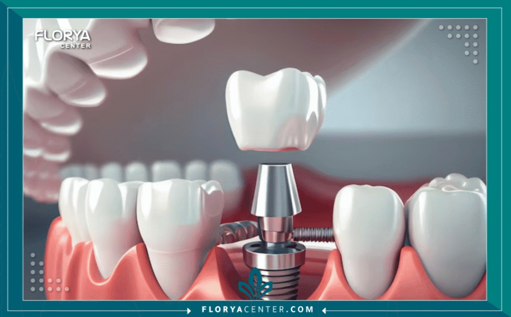 nouralagee93@gmail.com 20250728 135558 ٠٠٠٠ - مضاعفات فشل زراعة الأسنان تعتبر مضاعفات فشل زراعة الأسنان (Complications of Dental Implant Failure) من أكثر التحديات الطبية تعقيداً في مجال طب الأسنان الحديث. فعلى الرغم من أن زراعة الأسنان هي الإجراء الأكثر نجاحاً لاستبدال الأسنان المفقودة، بنسب نجاح تتجاوز 95%، إلا أن نسبة الفشل، وإن كانت ضئيلة، تحمل في طياتها عواقب وخيمة إذا لم تُدرَك وتُعالج في الوقت المنا Fس. إن فهم مضاعفات فشل زراعة الأسنان ليس مجرد مسألة معرفة طبية، بل هو ضرورة حتمية للحفاظ على صحة عظم الفك وتجنب المشاكل التي قد تكون دائمة.