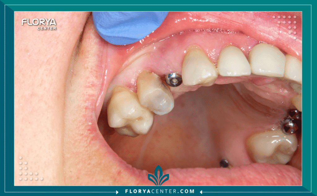 nouralagee93@gmail.com 20250728 135633 ٠٠٠٠ - مضاعفات فشل زراعة الأسنان تعتبر مضاعفات فشل زراعة الأسنان (Complications of Dental Implant Failure) من أكثر التحديات الطبية تعقيداً في مجال طب الأسنان الحديث. فعلى الرغم من أن زراعة الأسنان هي الإجراء الأكثر نجاحاً لاستبدال الأسنان المفقودة، بنسب نجاح تتجاوز 95%، إلا أن نسبة الفشل، وإن كانت ضئيلة، تحمل في طياتها عواقب وخيمة إذا لم تُدرَك وتُعالج في الوقت المنا Fس. إن فهم مضاعفات فشل زراعة الأسنان ليس مجرد مسألة معرفة طبية، بل هو ضرورة حتمية للحفاظ على صحة عظم الفك وتجنب المشاكل التي قد تكون دائمة.