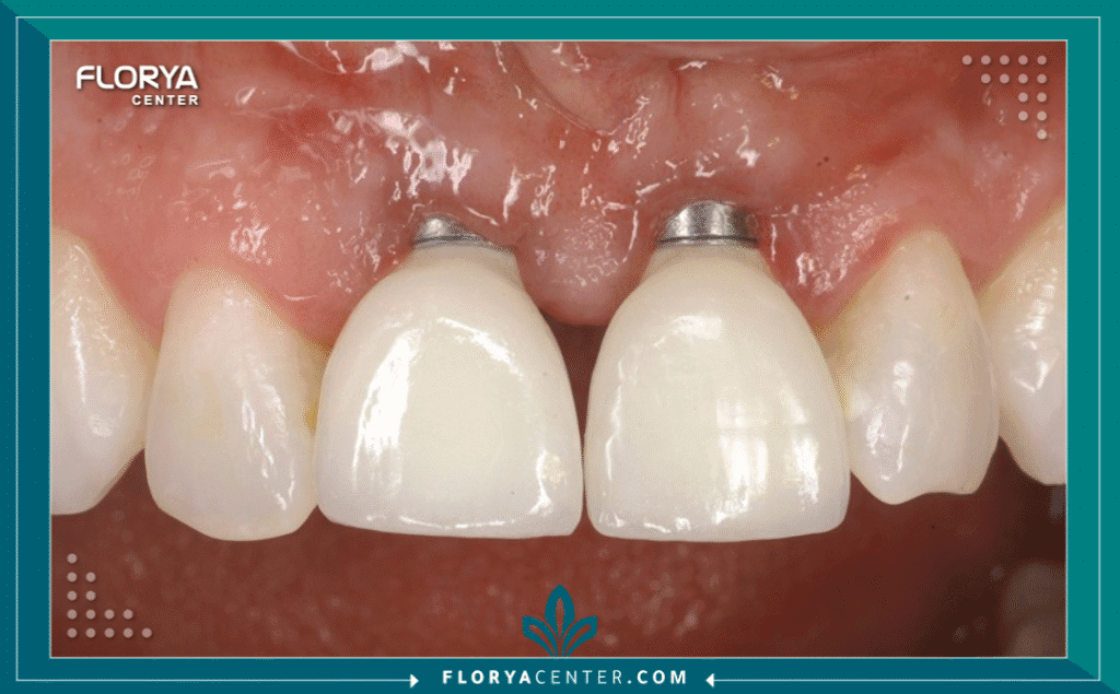 nouralagee93@gmail.com 20250728 135716 ٠٠٠٠ - مضاعفات فشل زراعة الأسنان تعتبر مضاعفات فشل زراعة الأسنان (Complications of Dental Implant Failure) من أكثر التحديات الطبية تعقيداً في مجال طب الأسنان الحديث. فعلى الرغم من أن زراعة الأسنان هي الإجراء الأكثر نجاحاً لاستبدال الأسنان المفقودة، بنسب نجاح تتجاوز 95%، إلا أن نسبة الفشل، وإن كانت ضئيلة، تحمل في طياتها عواقب وخيمة إذا لم تُدرَك وتُعالج في الوقت المنا Fس. إن فهم مضاعفات فشل زراعة الأسنان ليس مجرد مسألة معرفة طبية، بل هو ضرورة حتمية للحفاظ على صحة عظم الفك وتجنب المشاكل التي قد تكون دائمة.