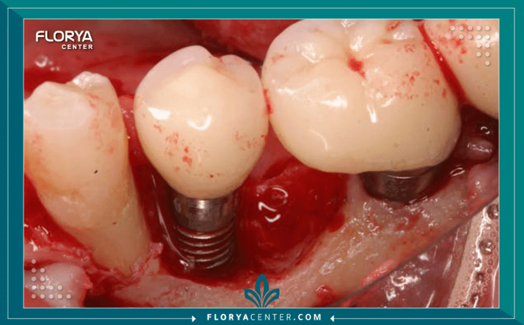 nouralagee93@gmail.com 20250728 135736 ٠٠٠٠ - مضاعفات فشل زراعة الأسنان تعتبر مضاعفات فشل زراعة الأسنان (Complications of Dental Implant Failure) من أكثر التحديات الطبية تعقيداً في مجال طب الأسنان الحديث. فعلى الرغم من أن زراعة الأسنان هي الإجراء الأكثر نجاحاً لاستبدال الأسنان المفقودة، بنسب نجاح تتجاوز 95%، إلا أن نسبة الفشل، وإن كانت ضئيلة، تحمل في طياتها عواقب وخيمة إذا لم تُدرَك وتُعالج في الوقت المنا Fس. إن فهم مضاعفات فشل زراعة الأسنان ليس مجرد مسألة معرفة طبية، بل هو ضرورة حتمية للحفاظ على صحة عظم الفك وتجنب المشاكل التي قد تكون دائمة.