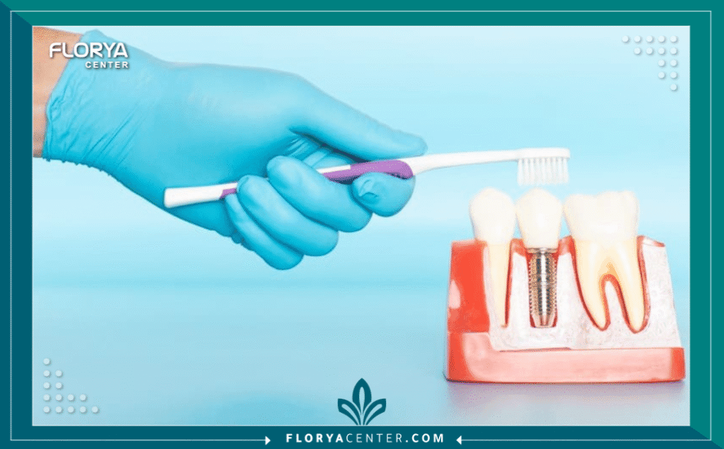 nouralagee93@gmail.com 20250728 165649 ٠٠٠٠ - العناية بالأسنان المزروعة العناية بالأسنان المزروعة (Caring for Dental Implants) هي العامل الحاسم لضمان استمرارية نجاحها، وهي لا تقل أهمية عن دقة الجراحة نفسها. يعتقد الكثيرون أن الزرعة، لكونها "اصطناعية"، لا تحتاج إلى عناية، وهذا هو الخطأ الأكثر شيوعاً الذي يؤدي إلى فشلها. على عكس السن الطبيعي، فإن الزرعة المكونة من التيتانيوم تكون أكثر حساسية للالتهابات البكتيرية.