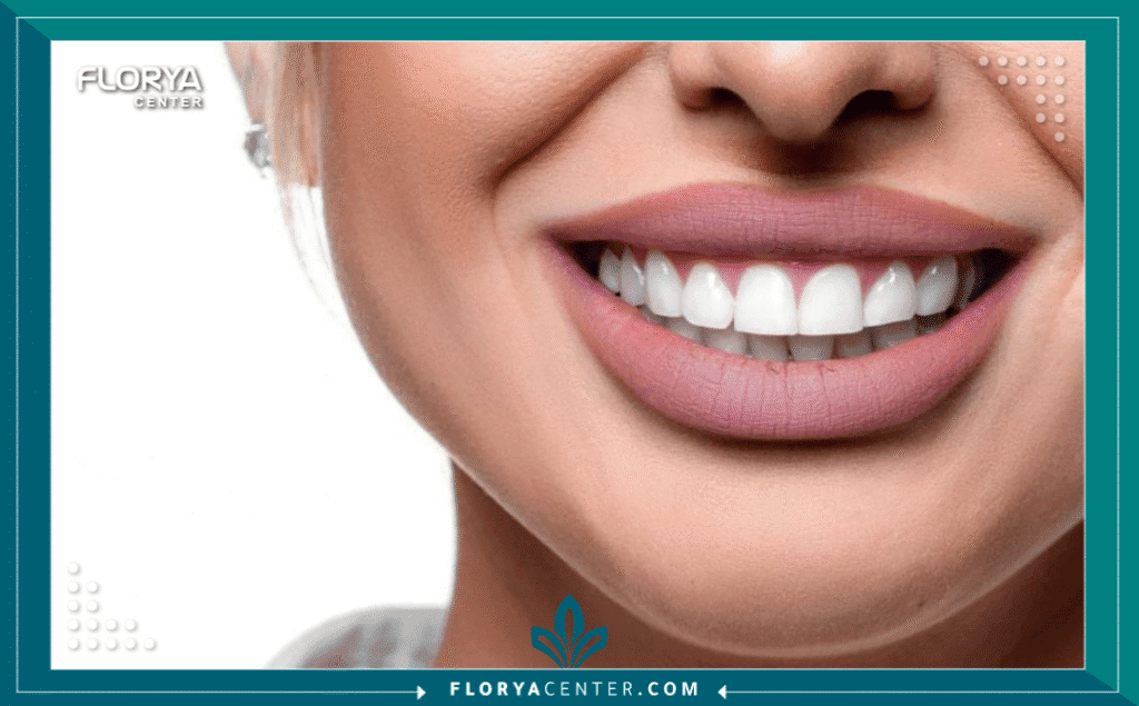 nouralagee93@gmail.com 20250731 161031 ٠٠٠٠ - ما هي ابتسامة هوليود؟ ما هي ابتسامة هوليود؟ (Hollywood Smile) هي ليست إجراءً طبياً محدداً بحد ذاته، بل هي مفهوم تجميلي شامل يهدف إلى تحقيق مظهر أسنان مثالي يتسم بالبياض الناصع، الاصطفاف المتكامل، والشكل المتناسق الذي نراه غالباً لدى المشاهير. على عكس الاعتقاد الشائع، لا يوجد إجراء واحد يسمى "ابتسامة هوليود"، بل هي النتيجة النهائية لمجموعة من إجراءات طب الأسنان التجميلي المصممة خصيصاً لكل فرد. في قلب هذا التحول الجمالي، تبرز "القشور الخزفية" (Veneers) باعتبارها الحجر الأساسي والأداة الأكثر فعالية لتحقيق هذا المظهر.