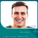 تقويم الأسنان للكبار