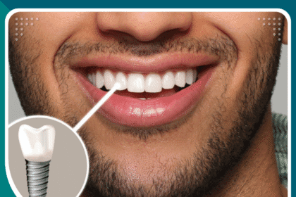 زراعة الأسنان خطوة بخطوة