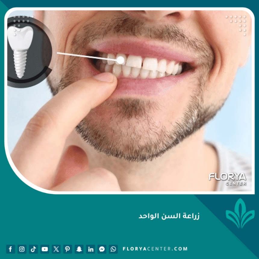 تكلفة زراعة السن الواحد