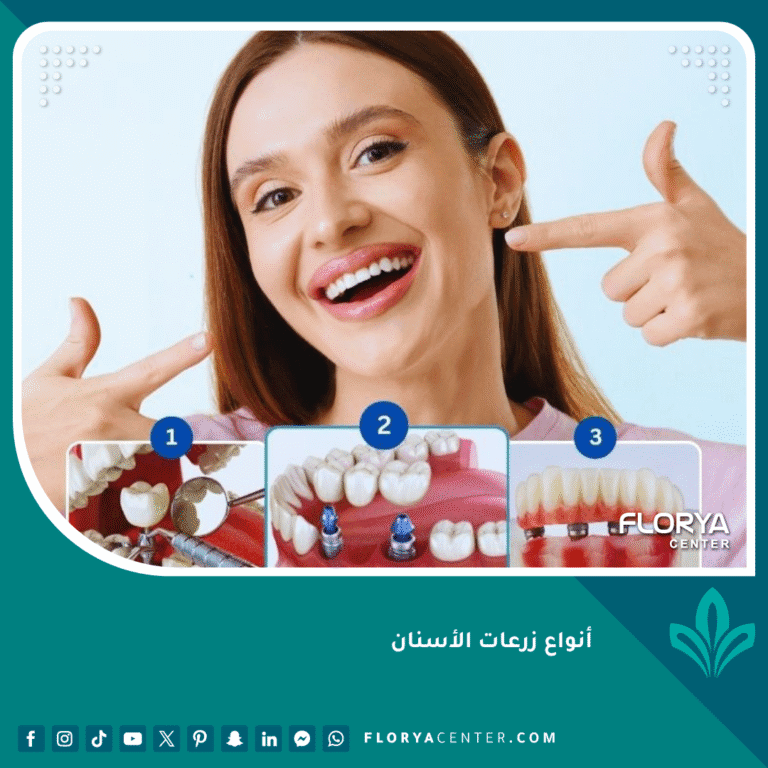 أنواع زرعات الأسنان