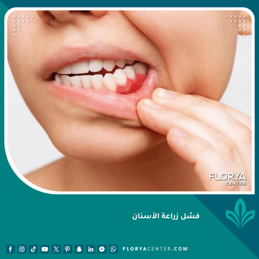 فشل زراعة الأسنان