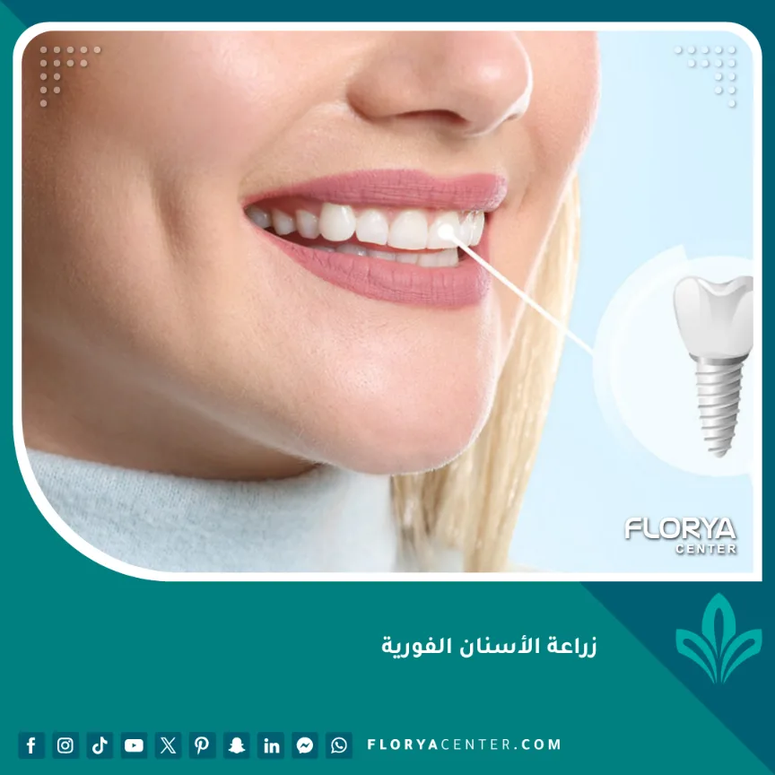 زراعة الأسنان الفورية