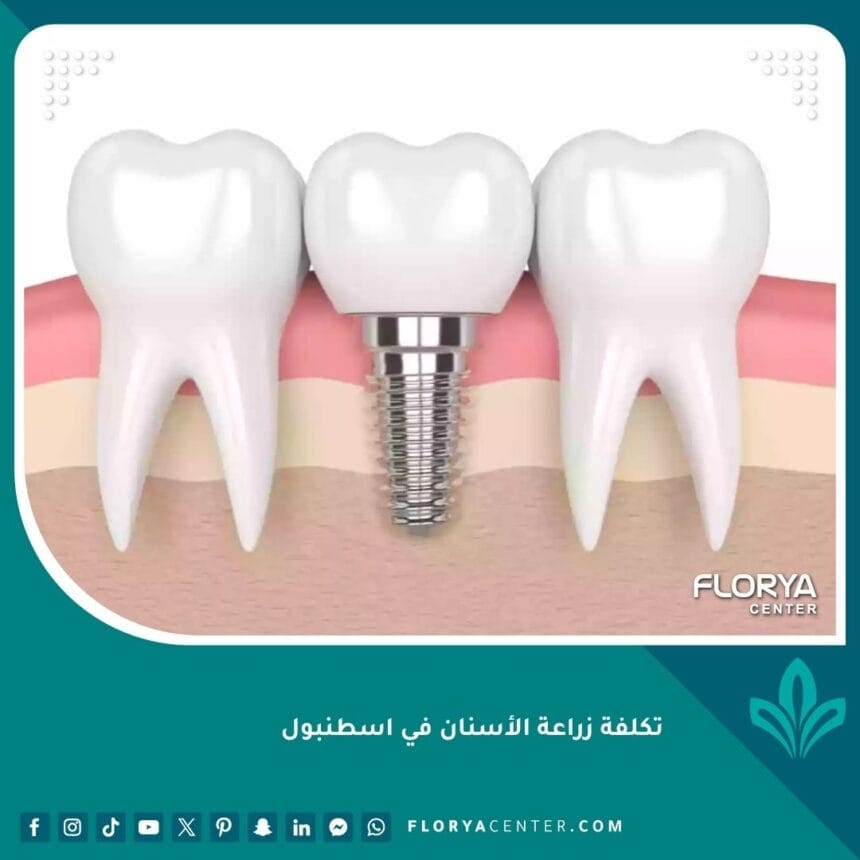 تكلفة زراعة الأسنان في اسطنبول