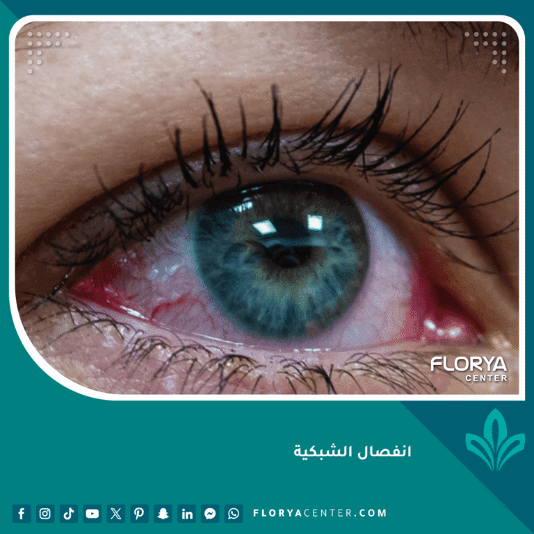 انفصال الشبكية