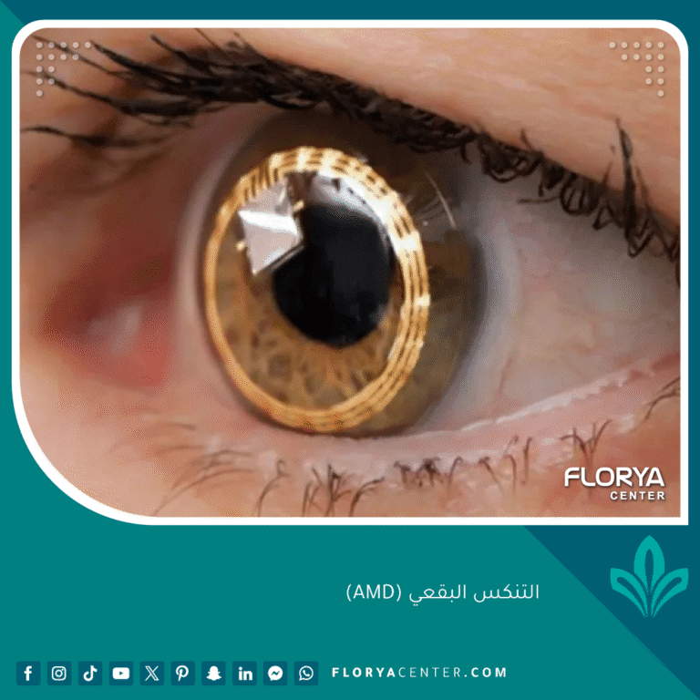 التنكس البقعي (AMD)