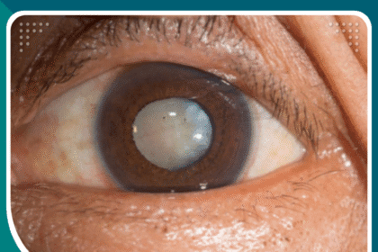 هل تسبب المياه البيضاء فقدان البصر؟