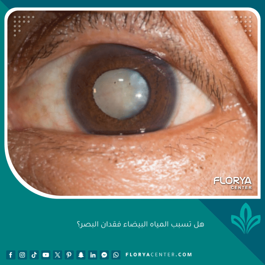 هل تسبب المياه البيضاء فقدان البصر؟