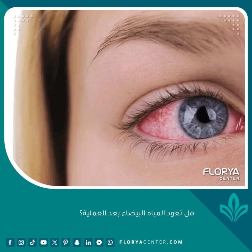 هل تعود المياه البيضاء بعد العملية؟ 1 هل تعود المياه البيضاء بعد العملية؟