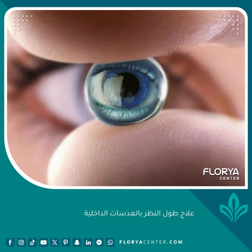 علاج طول النظر بالعدسات الداخلية 1 علاج طول النظر بالعدسات الداخلية