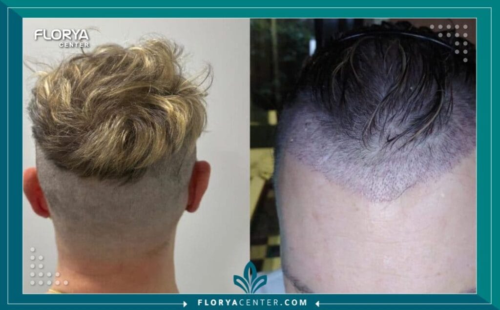 تقنية زراعة الشعر من دون حلاقة 2 - دكتور زراعة شعر في اسطنبول دكتور زراعة شعر في اسطنبول هو المطلب الأول لكل من يسعى لاستعادة ثقته بنفسه وتصحيح مشكلات تساقط الشعر والصلع الوراثي بأساليب جراحية متطورة. تشهد مدينة اسطنبول في عام 2026 طفرة غير مسبوقة في التقنيات الطبية، مما جعل البحث عن أفضل دكتور زراعة شعر في اسطنبول مهمة تتطلب الكثير من البحث والتدقيق لضمان الوصول إلى النتائج المرجوة بأمان تام.
