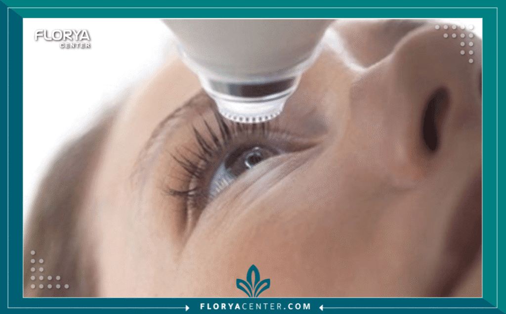 نسخة من Hayaalaje12 20250801 150535 ٠٠٠٠ - نصائح بعد عمليات العيون تُعد نصائح بعد عمليات العيون الركيزة الأساسية لضمان نجاح الإجراء الجراحي وتحقيق أفضل نتائج بصرية ممكنة. سواء كنت تخطط لإجراء تصحيح النظر أو علاج المياه البيضاء، فإن الالتزام الدقيق بمجموعة نصائح بعد عمليات العيون (Post-Eye Surgery Tips) هو ما يفصل بين الرؤية الواضحة والمضاعفات المحتملة. في تركيا، وتحديداً في مركز فلوريا (Florya Center)، نولي اهتماماً بالغاً لمرحلة ما بعد الجراحة، ونقدم برامج متابعة دقيقة تضمن سلامة عينيك. في هذا الدليل، نستعرض كل ما تحتاج معرفته لرحلة تعافٍ آمنة وسريعة.