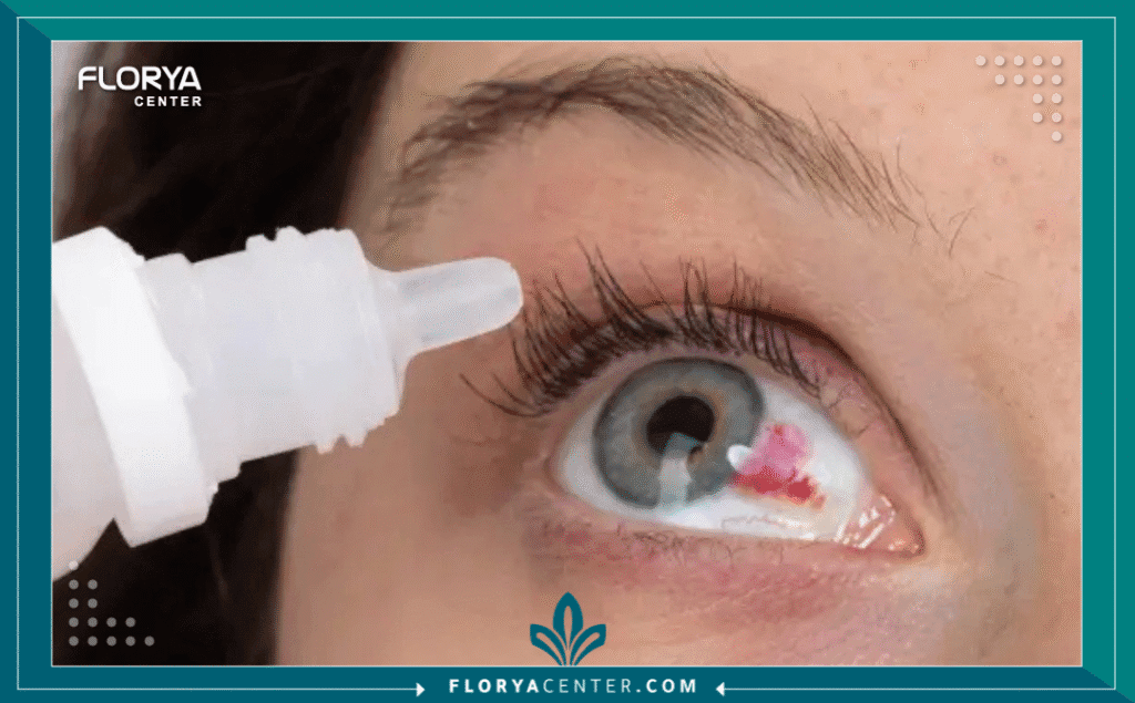 نسخة من Hayaalaje12 20250806 153514 ٠٠٠٠ 1 - ضغط العين وأعراض الصداع يُعد الارتباط بين ضغط العين وأعراض الصداع (Ocular Hypertension and Headache Symptoms) أحد أكثر المواضيع إثارة للقلق في مجال طب العيون. كثير من الناس يعانون من الصداع ويبحثون بقلق عن احتمال وجود صلة بينه وبين ارتفاع ضغط العين، خاصة مع الخوف الكامن من فقدان البصر المرتبط بالجلوكوما (الزرق). هذا القلق مفهوم، فهل كل صداع مؤشر على خطر يهدد عينيك؟