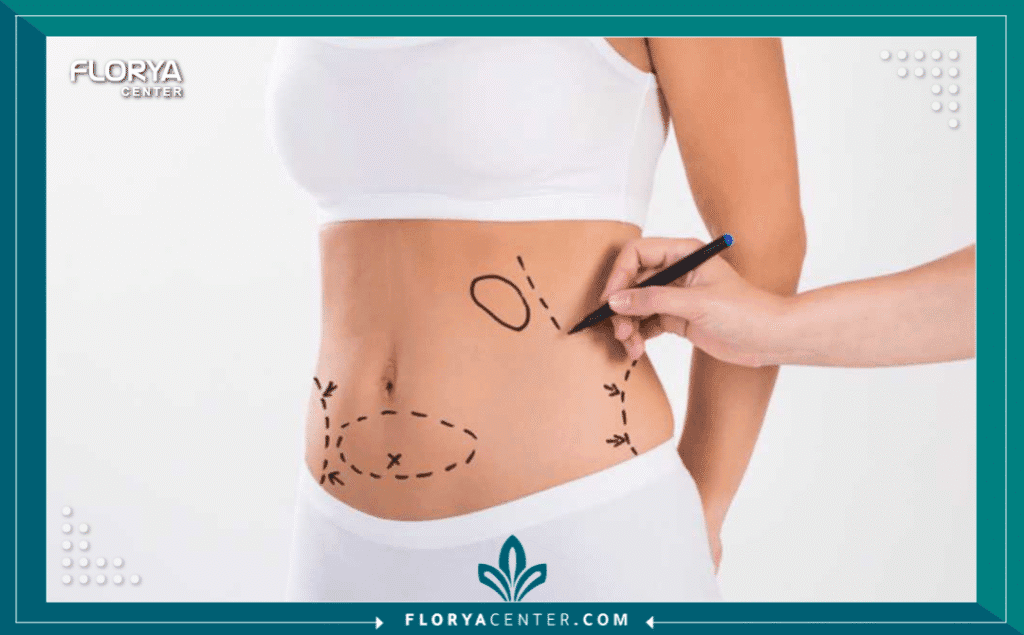 عمليات شفط الدهون في اسطنبول 3 نسخة من Hayaalaje12 20250811 231817 ٠٠٠٠ 2 - عمليات شفط الدهون في اسطنبول هل تنظر في المرآة وتحلم باستعادة تناسق جسدك الذي أخفته التراكمات الدهنية العنيدة؟ إن عمليات شفط الدهون في اسطنبول (Liposuction) ليست مجرد إجراء تجميلي عابر، بل هي بوابتك الذهبية لاستعادة الثقة بالنفس والزمن الجميل من خلال نحت القوام بدقة متناهية. في ظل التطور الطبي الهائل، تحولت هذه العملية من مجرد إزالة للدهون إلى فن نحت الجسم (Body Contouring) الذي يعيد رسم المنحنيات ببراعة.