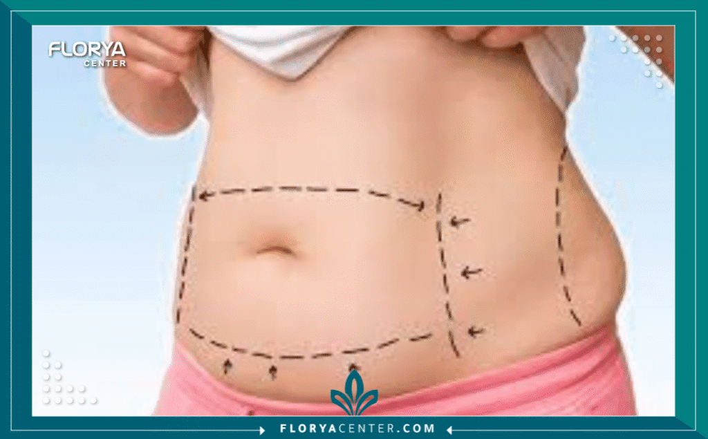 نسخة من Hayaalaje12 20250811 231843 ٠٠٠٠ 2 - دكتور شفط دهون في تركيا دكتور شفط دهون في تركيا (Liposuction Doctor in Turkey) أصبح وجهة مثالية للراغبين في التخلص من الدهون الزائدة وتحسين مظهر الجسم باستخدام أحدث التقنيات الطبية. تركيا تقدم مزيجًا من الأسعار المناسبة والخبرة الطبية العالية، مما يجعلها مقصدًا للمرضى من جميع أنحاء العالم. الأطباء الأتراك يتميزون بالاحترافية والمتابعة الدقيقة قبل وبعد العملية لضمان نتائج طبيعية وآمنة.