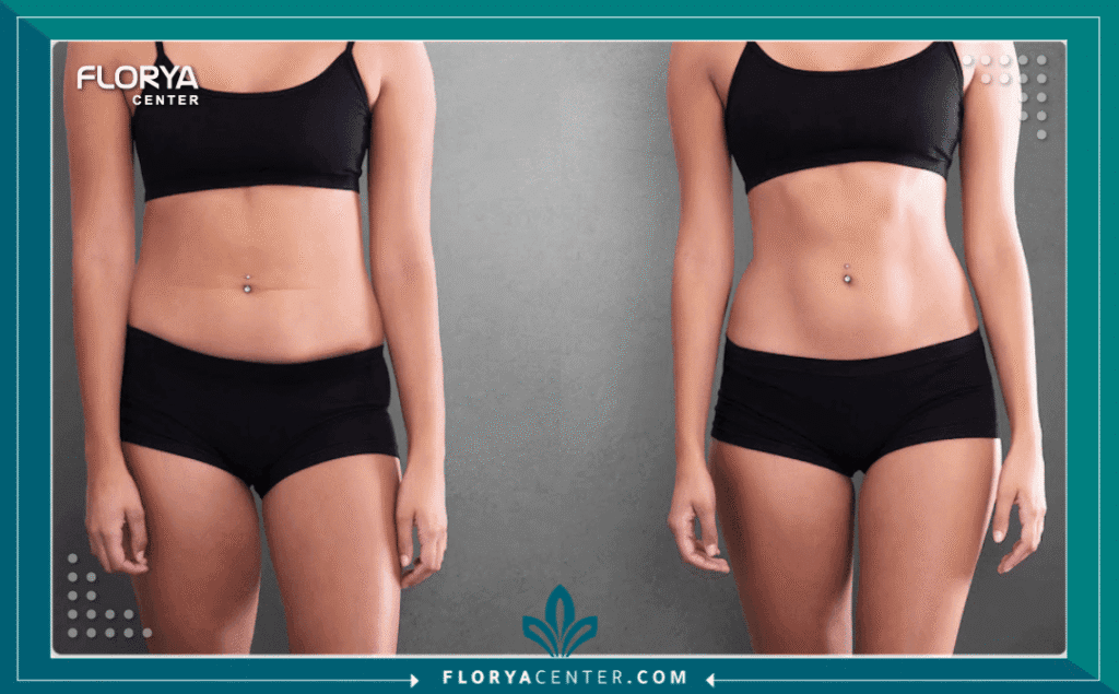 نسخة من Hayaalaje12 20250811 231947 ٠٠٠٠ 2 - دكتور شفط دهون في تركيا دكتور شفط دهون في تركيا (Liposuction Doctor in Turkey) أصبح وجهة مثالية للراغبين في التخلص من الدهون الزائدة وتحسين مظهر الجسم باستخدام أحدث التقنيات الطبية. تركيا تقدم مزيجًا من الأسعار المناسبة والخبرة الطبية العالية، مما يجعلها مقصدًا للمرضى من جميع أنحاء العالم. الأطباء الأتراك يتميزون بالاحترافية والمتابعة الدقيقة قبل وبعد العملية لضمان نتائج طبيعية وآمنة.