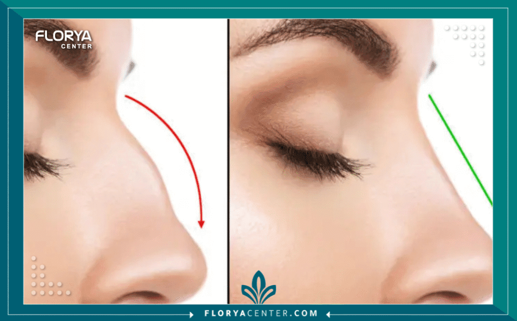 نسخة من Hayaalaje12 20250815 023102 ٠٠٠٠ 1 - دكتور تجميل أنف في تركيا يُعد اتخاذ القرار بالخضوع لجراحة تجميلية خطوة مصيرية، ويأتي البحث عن أفضل دكتور تجميل أنف في تركيا على رأس أولويات الآلاف من المرضى سنويًا، نظرًا للمكانة العالمية التي اكتسبتها إسطنبول كعاصمة لهذه الجراحات الدقيقة. إن عملية تجميل الأنف (Rhinoplasty) ليست مجرد إجراء تجميلي، بل هي مزيج معقد من الفن والنحت الطبي والهندسة الوظيفية لتحسين التنفس والمظهر معًا.