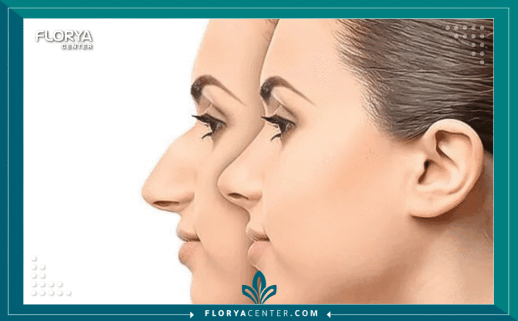 نسخة من Hayaalaje12 20250815 023135 ٠٠٠٠ - جراحة التجميل في اسطنبول إن اتخاذ قرار الخضوع لمشرط الجراح ليس بالأمر الهين؛ إنه قرار مصيري يجمع بين الرغبة في تحسين المظهر والحاجة إلى ضمان السلامة الطبية المطلقة. هنا تبرز جراحة التجميل في اسطنبول (Plastic Surgery in Istanbul) كخيار أول للملايين حول العالم، ليس فقط لجمال المدينة، بل لأنها تحولت فعلياً إلى "عاصمة الجراحة الدقيقة" في الشرق الأوسط وأوروبا. في هذه المدينة، لا يتم التعامل مع الجراحة كإجراء ترفيهي فحسب، بل كمنظومة طبية متكاملة تخضع لأدق معايير الرقابة الصحية، حيث يجتمع الفن الجراحي مع التكنولوجيا المتطورة في غرف عمليات تنافس نظيراتها في ألمانيا والولايات المتحدة، لتقدم لك نتائج تغير مسار حياتك للأبد.