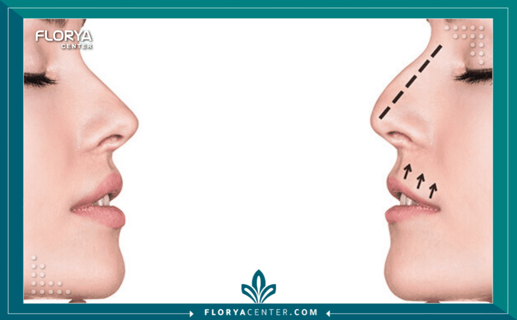 نسخة من Hayaalaje12 20250815 023208 ٠٠٠٠ - دكتور تجميل أنف في تركيا يُعد اتخاذ القرار بالخضوع لجراحة تجميلية خطوة مصيرية، ويأتي البحث عن أفضل دكتور تجميل أنف في تركيا على رأس أولويات الآلاف من المرضى سنويًا، نظرًا للمكانة العالمية التي اكتسبتها إسطنبول كعاصمة لهذه الجراحات الدقيقة. إن عملية تجميل الأنف (Rhinoplasty) ليست مجرد إجراء تجميلي، بل هي مزيج معقد من الفن والنحت الطبي والهندسة الوظيفية لتحسين التنفس والمظهر معًا.