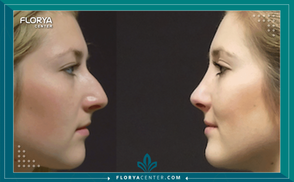 نسخة من Hayaalaje12 20250815 023239 ٠٠٠٠ 1 - دكتور تجميل أنف في تركيا يُعد اتخاذ القرار بالخضوع لجراحة تجميلية خطوة مصيرية، ويأتي البحث عن أفضل دكتور تجميل أنف في تركيا على رأس أولويات الآلاف من المرضى سنويًا، نظرًا للمكانة العالمية التي اكتسبتها إسطنبول كعاصمة لهذه الجراحات الدقيقة. إن عملية تجميل الأنف (Rhinoplasty) ليست مجرد إجراء تجميلي، بل هي مزيج معقد من الفن والنحت الطبي والهندسة الوظيفية لتحسين التنفس والمظهر معًا.