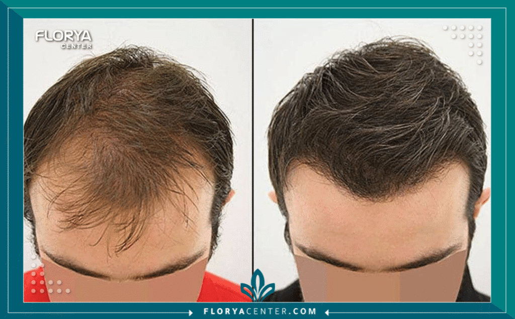 نسخة من Hayaalaje12 20250816 115753 ٠٠٠٠ - دكتور زراعة شعر في اسطنبول دكتور زراعة شعر في اسطنبول هو المطلب الأول لكل من يسعى لاستعادة ثقته بنفسه وتصحيح مشكلات تساقط الشعر والصلع الوراثي بأساليب جراحية متطورة. تشهد مدينة اسطنبول في عام 2026 طفرة غير مسبوقة في التقنيات الطبية، مما جعل البحث عن أفضل دكتور زراعة شعر في اسطنبول مهمة تتطلب الكثير من البحث والتدقيق لضمان الوصول إلى النتائج المرجوة بأمان تام.