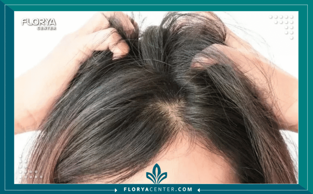 نسخة من Hayaalaje12 20250816 115813 ٠٠٠٠ - دكتور زراعة شعر في اسطنبول دكتور زراعة شعر في اسطنبول هو المطلب الأول لكل من يسعى لاستعادة ثقته بنفسه وتصحيح مشكلات تساقط الشعر والصلع الوراثي بأساليب جراحية متطورة. تشهد مدينة اسطنبول في عام 2026 طفرة غير مسبوقة في التقنيات الطبية، مما جعل البحث عن أفضل دكتور زراعة شعر في اسطنبول مهمة تتطلب الكثير من البحث والتدقيق لضمان الوصول إلى النتائج المرجوة بأمان تام.