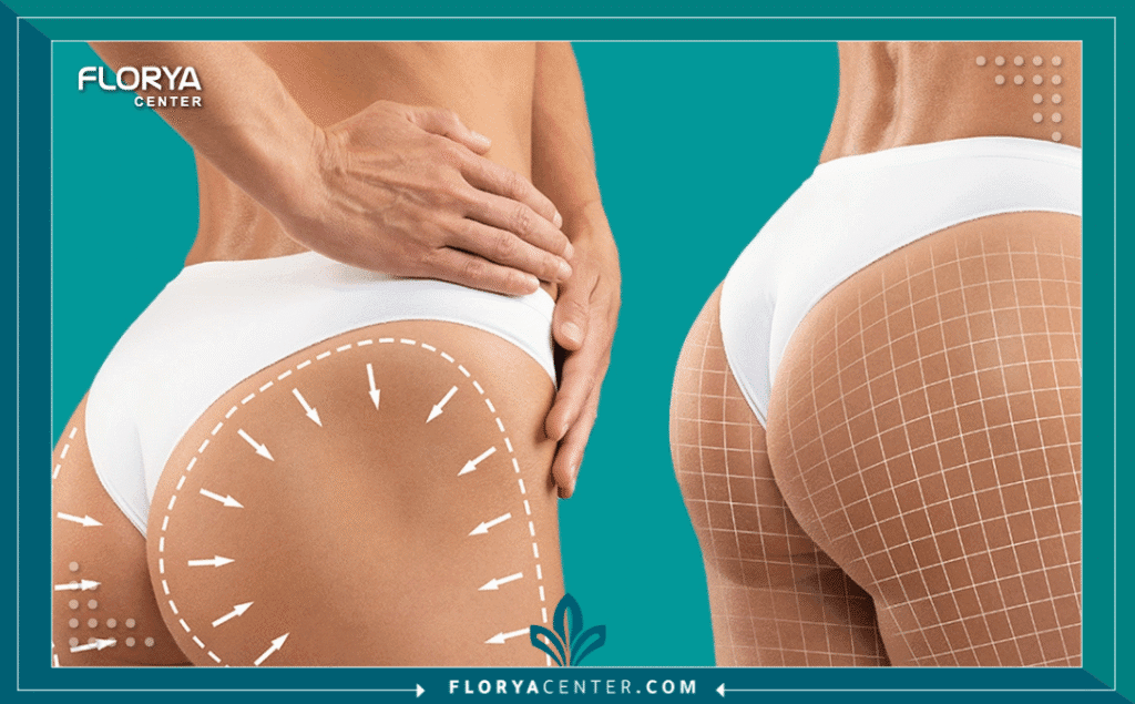 نسخة من Hayaalaje12 20250819 134804 ٠٠٠٠ 1 - جراح تكبير المؤخرة في تركيا يعد البحث عن أفضل جراح تكبير المؤخرة في تركيا هو الخطوة الجوهرية لضمان الحصول على قوام متناسق ونتائج آمنة ومستدامة في آن واحد.