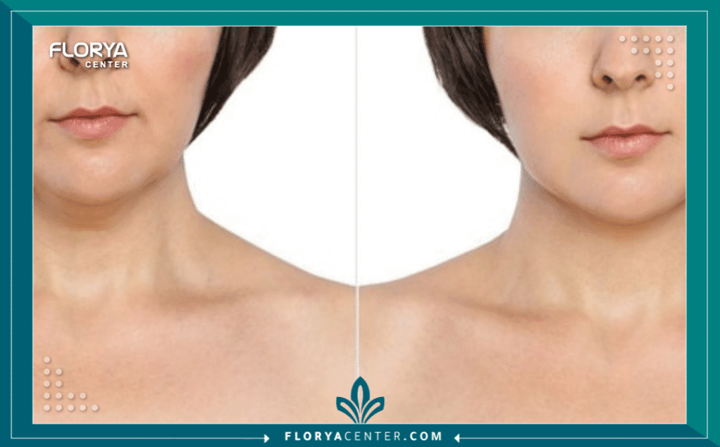 نسخة من Hayaalaje12 20250819 134932 ٠٠٠٠ - طبيب تصغير الذقن في تركيا يعتبر اختيار أفضل طبيب تصغير الذقن في تركيا هو الخطوة الأهم والأكثر حساسية لكل من يسعى لتحقيق التناغم الوجهي والحصول على مظهر (V-Line) المثالي أو تحديد الفك القوي. إن جراحة تجميل الذقن ليست مجرد إجراء تجميلي سطحي، بل هي عملية دقيقة تتطلب مهارة جراحية عالية في التعامل مع بنية العظم والأعصاب المحيطة. في السنوات الأخيرة، أصبحت إسطنبول العاصمة العالمية لهذه الجراحات، مما جعل التنافس على لقب طبيب تصغير الذقن في تركيا شديداً للغاية، حيث توفر العيادات تقنيات متطورة تضاهي المعايير الأوروبية وبأسعار تنافسية.