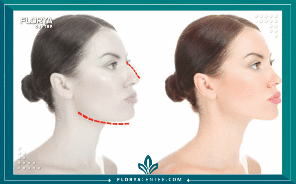 نسخة من Hayaalaje12 20250819 134959 ٠٠٠٠ - طبيب تصغير الذقن في تركيا يعتبر اختيار أفضل طبيب تصغير الذقن في تركيا هو الخطوة الأهم والأكثر حساسية لكل من يسعى لتحقيق التناغم الوجهي والحصول على مظهر (V-Line) المثالي أو تحديد الفك القوي. إن جراحة تجميل الذقن ليست مجرد إجراء تجميلي سطحي، بل هي عملية دقيقة تتطلب مهارة جراحية عالية في التعامل مع بنية العظم والأعصاب المحيطة. في السنوات الأخيرة، أصبحت إسطنبول العاصمة العالمية لهذه الجراحات، مما جعل التنافس على لقب طبيب تصغير الذقن في تركيا شديداً للغاية، حيث توفر العيادات تقنيات متطورة تضاهي المعايير الأوروبية وبأسعار تنافسية.