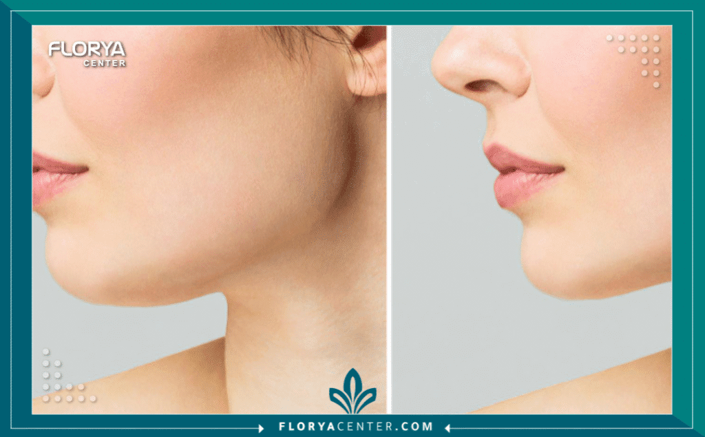 نسخة من Hayaalaje12 20250819 135106 ٠٠٠٠ - طبيب تصغير الذقن في تركيا يعتبر اختيار أفضل طبيب تصغير الذقن في تركيا هو الخطوة الأهم والأكثر حساسية لكل من يسعى لتحقيق التناغم الوجهي والحصول على مظهر (V-Line) المثالي أو تحديد الفك القوي. إن جراحة تجميل الذقن ليست مجرد إجراء تجميلي سطحي، بل هي عملية دقيقة تتطلب مهارة جراحية عالية في التعامل مع بنية العظم والأعصاب المحيطة. في السنوات الأخيرة، أصبحت إسطنبول العاصمة العالمية لهذه الجراحات، مما جعل التنافس على لقب طبيب تصغير الذقن في تركيا شديداً للغاية، حيث توفر العيادات تقنيات متطورة تضاهي المعايير الأوروبية وبأسعار تنافسية.