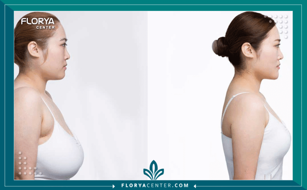 نسخة من Hayaalaje12 20250819 233730 ٠٠٠٠ - دكتور تصغير الصدر في اسطنبول إن البحث عن أفضل دكتور تصغير الصدر في اسطنبول ليس مجرد خطوة تجميلية، بل هو قرار طبي حاسم يهدف إلى تحسين جودة الحياة والتخلص من الآلام المزمنة التي يسببها تضخم الثدي (Macromastia). لقد أصبحت تركيا، وتحديداً اسطنبول، الوجهة الأولى عالمياً لهذا الإجراء بفضل الجمع بين الخبرة الجراحية العالية والتكلفة المدروسة. في هذا الدليل، سنضع بين يديك المعايير الدقيقة لاختيار الجراح المناسب لضمان نتائج آمنة ومستدامة.