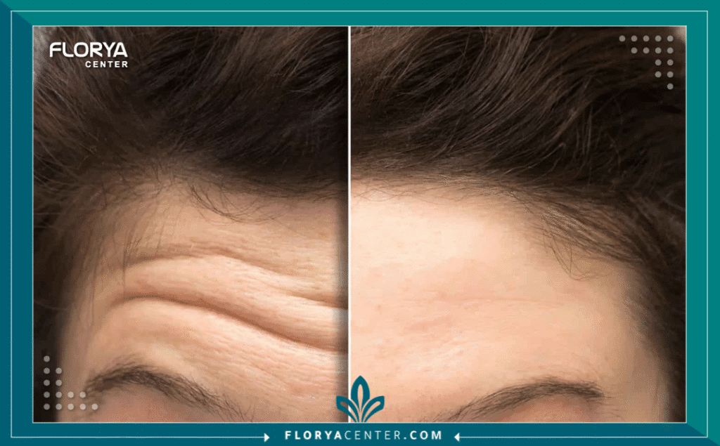 نسخة من Hayaalaje12 20250822 162236 ٠٠٠٠ - عيادة شد البشرة في اسطنبول إن قرار البحث عن أفضل عيادة شد البشرة في اسطنبول يمثل نقطة تحول جوهرية لكل من يسعى لاستعادة شباب البشرة وحيويتها، سواء عبر التدخل الجراحي أو التقنيات غير الجراحية الحديثة. لقد تحولت تركيا، واسطنبول تحديداً، إلى عاصمة عالمية للجمال، حيث تستقبل الآلاف شهرياً بفضل الجودة الطبية الفائقة والأسعار التنافسية.