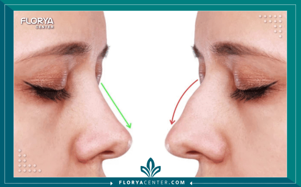 نسخة من Hayaalaje12 20250822 162311 ٠٠٠٠ - جراح تجميل الأنف المفتوح في تركيا يعد البحث عن أفضل جراح تجميل الأنف المفتوح في تركيا الخطوة الأكثر حسمًا في رحلة التغيير نحو الجمال والتناسق، حيث تتطلب هذه الجراحة دقة متناهية وخبرة عميقة في التعامل مع بنية الأنف المعقدة. إن اختيارك الصحيح للطبيب لا يضمن فقط شكلاً جمالياً، بل يحافظ على الوظيفة التنفسية للأنف بأعلى كفاءة. في هذا الدليل الشامل، سنضع بين يديك خلاصة البحث المكثف لمساعدتك في الوصول إلى جراح تجميل الأنف المفتوح في تركيا الذي يمتلك السجل الأقوى والسمعة الأفضل، لضمان تجربة آمنة ونتائج توافق تطلعاتك.