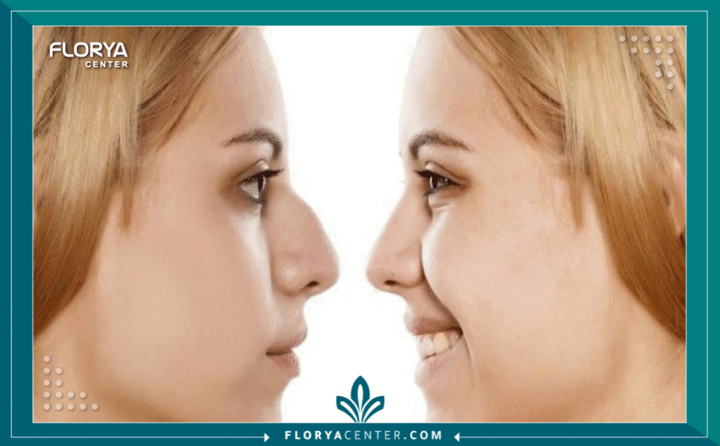 نسخة من Hayaalaje12 20250822 162348 ٠٠٠٠ - جراح تجميل الأنف المفتوح في تركيا يعد البحث عن أفضل جراح تجميل الأنف المفتوح في تركيا الخطوة الأكثر حسمًا في رحلة التغيير نحو الجمال والتناسق، حيث تتطلب هذه الجراحة دقة متناهية وخبرة عميقة في التعامل مع بنية الأنف المعقدة. إن اختيارك الصحيح للطبيب لا يضمن فقط شكلاً جمالياً، بل يحافظ على الوظيفة التنفسية للأنف بأعلى كفاءة. في هذا الدليل الشامل، سنضع بين يديك خلاصة البحث المكثف لمساعدتك في الوصول إلى جراح تجميل الأنف المفتوح في تركيا الذي يمتلك السجل الأقوى والسمعة الأفضل، لضمان تجربة آمنة ونتائج توافق تطلعاتك.