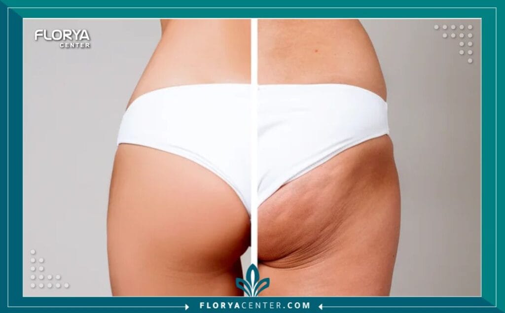 C1 1 - عمليات تجميل الأرداف والسيقان في تركيا هل تشعرين بأن عدم تناسق النصف السفلي من جسمك يقف حاجزاً أمام ثقتك بنفسك واختيارك للملابس التي تحبين؟ إن عمليات تجميل الأرداف والسيقان في تركيا (Lower Body Contouring) لم تعد مجرد رفاهية تجميلية، بل تحولت إلى حل جذري وفعال لاستعادة التوازن الجسدي والنفسي الذي طالما حلمتِ به. مع التطور الطبي الهائل، أصبح بإمكانك الآن نحت القوام بدقة متناهية، والتخلص من الترهلات العنيدة، والحصول على منحنيات أنثوية جذابة بأمان تام. تركيا اليوم ليست مجرد وجهة سياحية، بل هي عاصمة الطب التجميلي التي يقصدها الآلاف سنوياً لتحويل أحلامهم إلى واقع ملموس، مستفيدين من خبرات جراحية عالمية وتقنيات لا تتوفر بسهولة في أماكن أخرى.